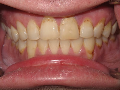 Dental Implants Before