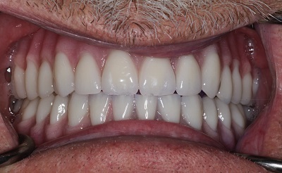 dentures should be characterized to look like a natural smile