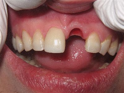 Trauma tooth loss as teen