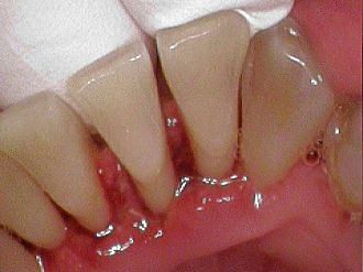 Bloody teeth indicating gum disease