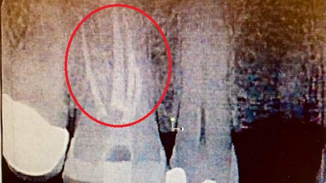 xray image of completed root canal