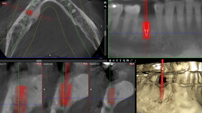 Placing Dental Implants [Technology] | Cranford Dental