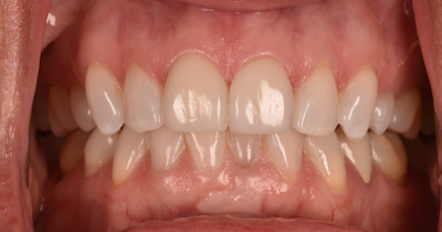 Before and after photos of veneers on front teeth.